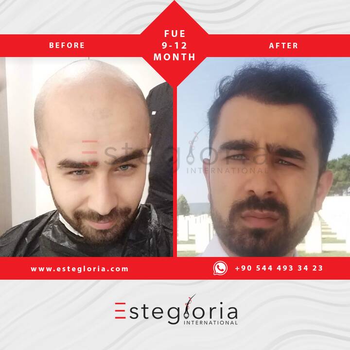 Estegloria saç ekim konusunda ülkemizi dünyada gururla temsil ediyor!